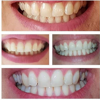 Carbón White| Blanqueador dental